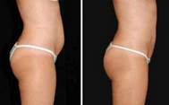 Van de de Laser Vacuümrf Ultrasone Liposuction Cavitatie van de Lipodiode het Vermageringsdieetmachine gecontroleerde levering 3