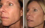 Van de de Laser Vacuümrf Ultrasone Liposuction Cavitatie van de Lipodiode het Vermageringsdieetmachine gecontroleerde levering 4