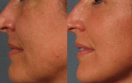 Van de de Laser Vacuümrf Ultrasone Liposuction Cavitatie van de Lipodiode het Vermageringsdieetmachine gecontroleerde levering 5