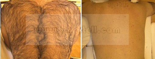 De Machine van de het Haarverwijdering van de diodelaser, het Huisgebruik 808nm van Laserepilator voor Vrouwenlichaam