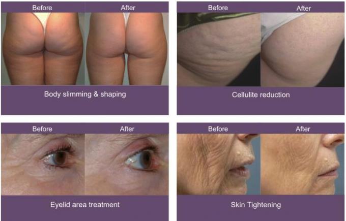 100kPa de vacuüm van de de Rolmassage van Liposuction Bipolaire rf van de Vermageringsdieetmachine Verre Infrarode Velum
