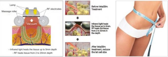 100kPa de vacuüm van de de Rolmassage van Liposuction Bipolaire rf van de Vermageringsdieetmachine Verre Infrarode Velum