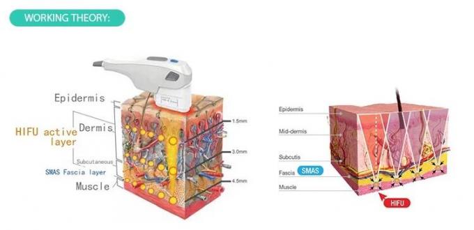 Van de de Schoonheidsmachine 50-60Hz van ultrasone klank de Draagbare Hifu Goedkeuring van Ce Intensiteit Geconcentreerde