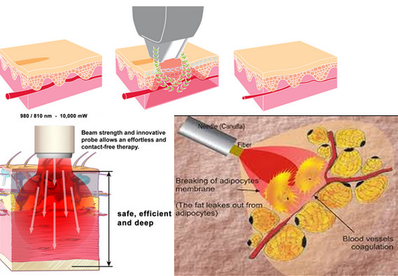 Pijnloze de Verwijderingsmachine van de Spinader, Materiaal van de Diode het Kosmetische Laser voor EVLT